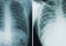 Peste neumónica: muerte de epidemióloga en Rusia genera investigación